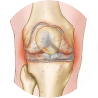 Knee Osteoarthritis
