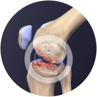 Joint Pain