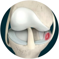 Arthritis