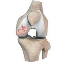 Knee Swelling & Stiffness