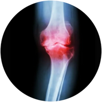 Cartilage Erosion